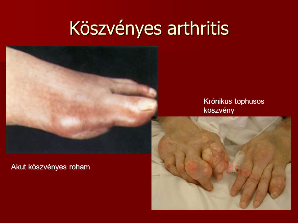 osteoarthritis 2 fokos hogyan kell kezelni enyhíti a vállfájdalmakat